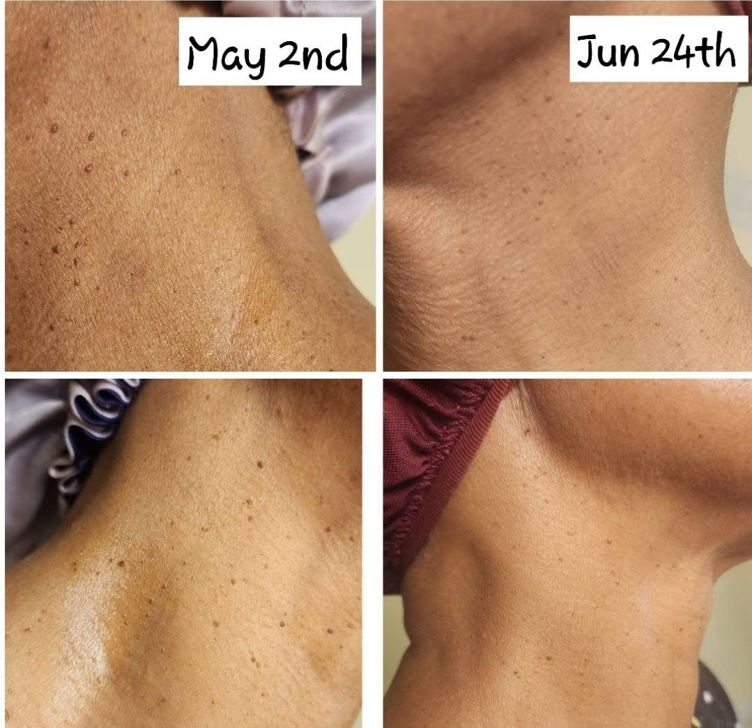 Beverly · neck skin tags before and after the Feel Great Protocol
